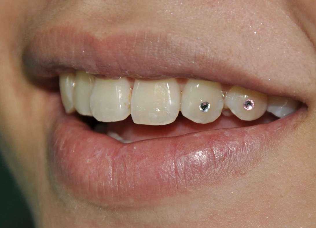Способы декорирования зубов скайсами в виде бриллианта или страз: как происходит установка?