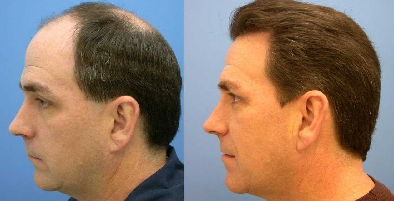 Трансплантация волос до и после