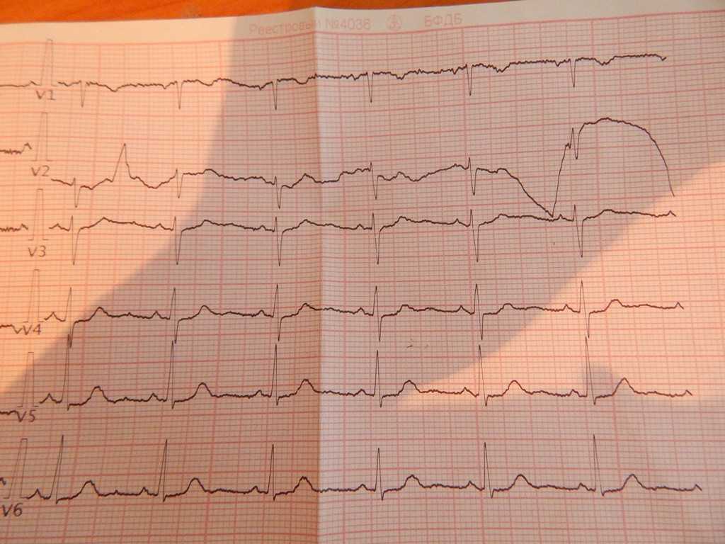 Идеальная кардиограмма сердца фото