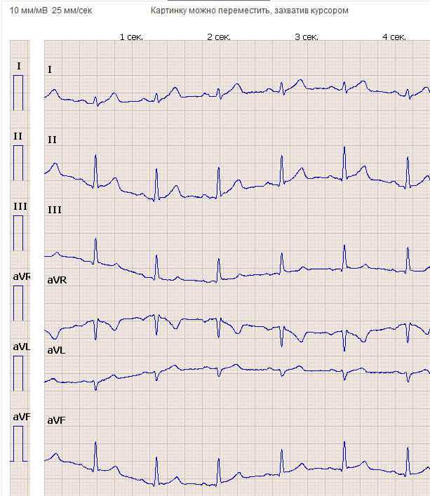 Кардиограмма здорового человека картинка