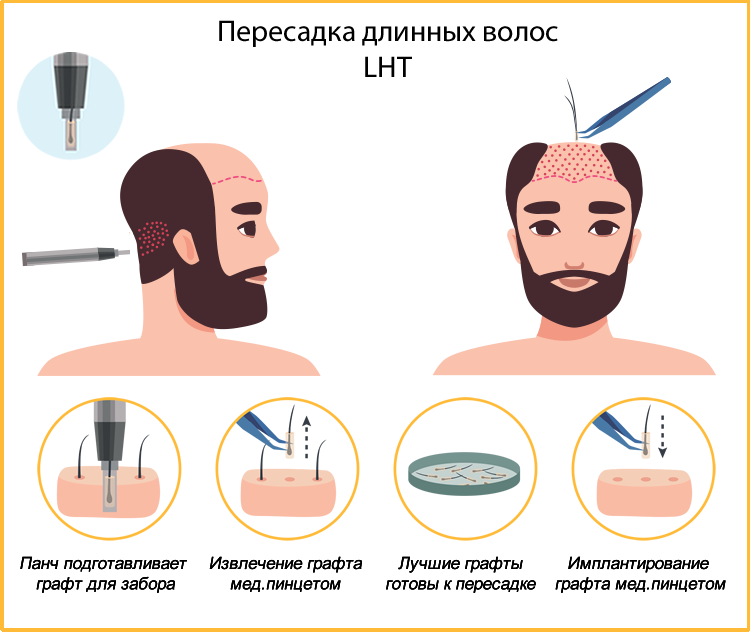 Методы пересадки волос. Пересадка длинных волос. Лоскутный метод пересадки волос.