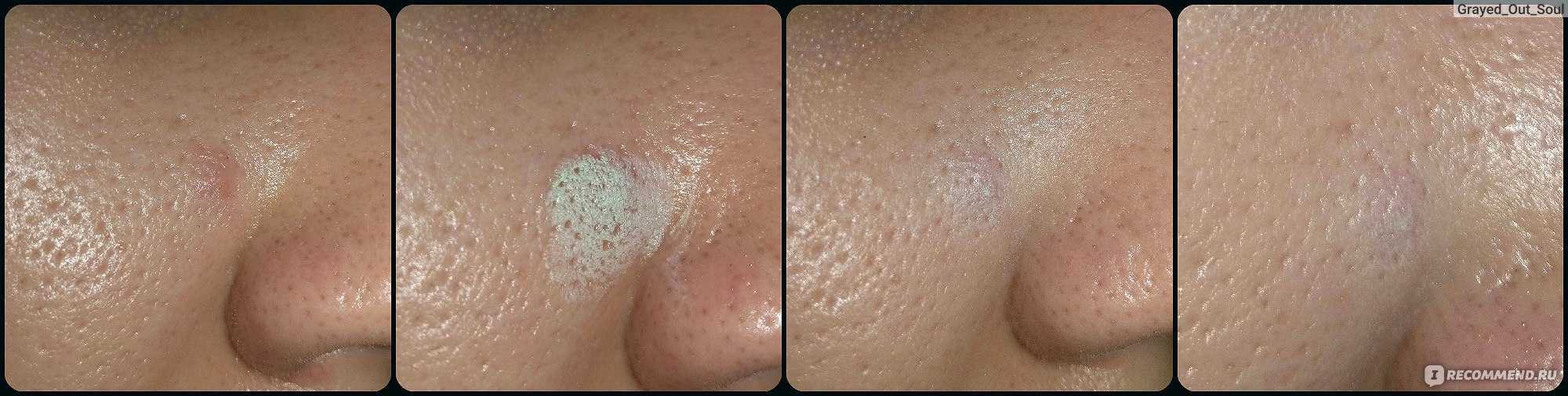 Шелушится кожа на лице: причины и как убрать шелушение с поомщью кремов, витаминов и скрабов